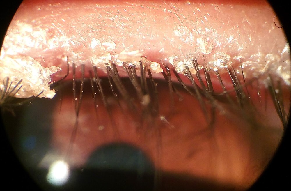 Close-up photo of blepharitis (palkon par papdi): flaky, crusty scales stuck to the base of the eyelashes