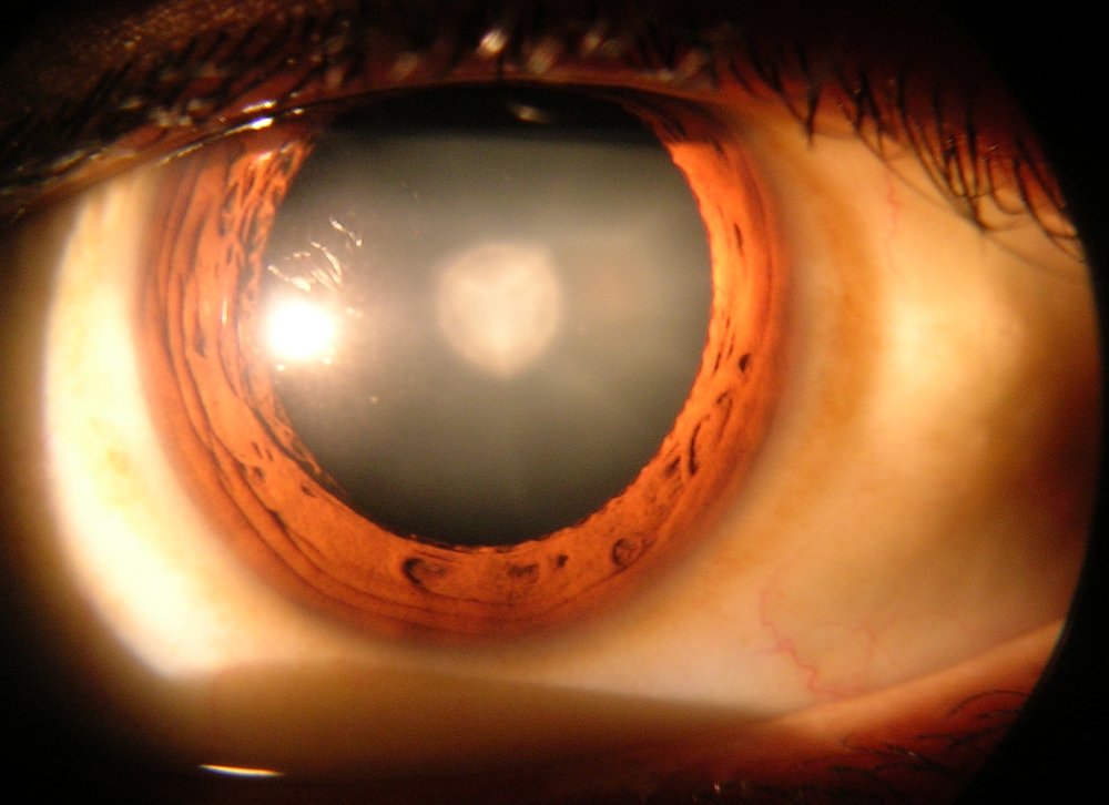 Close-up photo of an eye with a mature cataract (motiyabind): the pupil looks cloudy white-grey instead of black