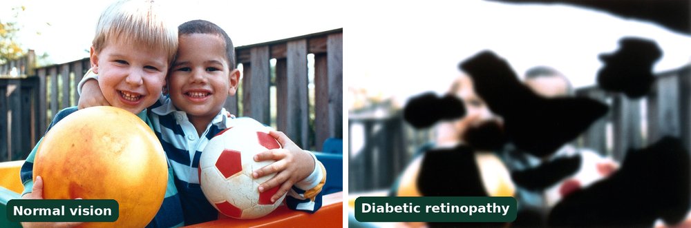 Vision simulation of diabetic retinopathy (sugar se retina ki bimari): the same photo of two boys holding balls shown with normal vision on the left and as seen with diabetic retinopathy on the right