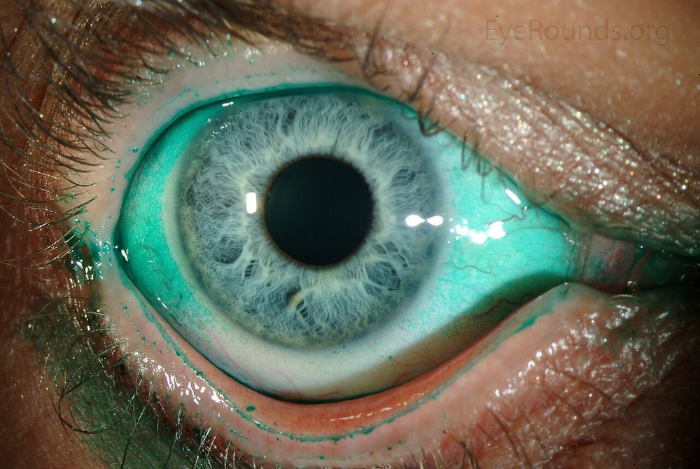Clinical photo of dry eye disease (aankhon ka sukhapan): a green diagnostic dye stains the dry, damaged surface of the eye