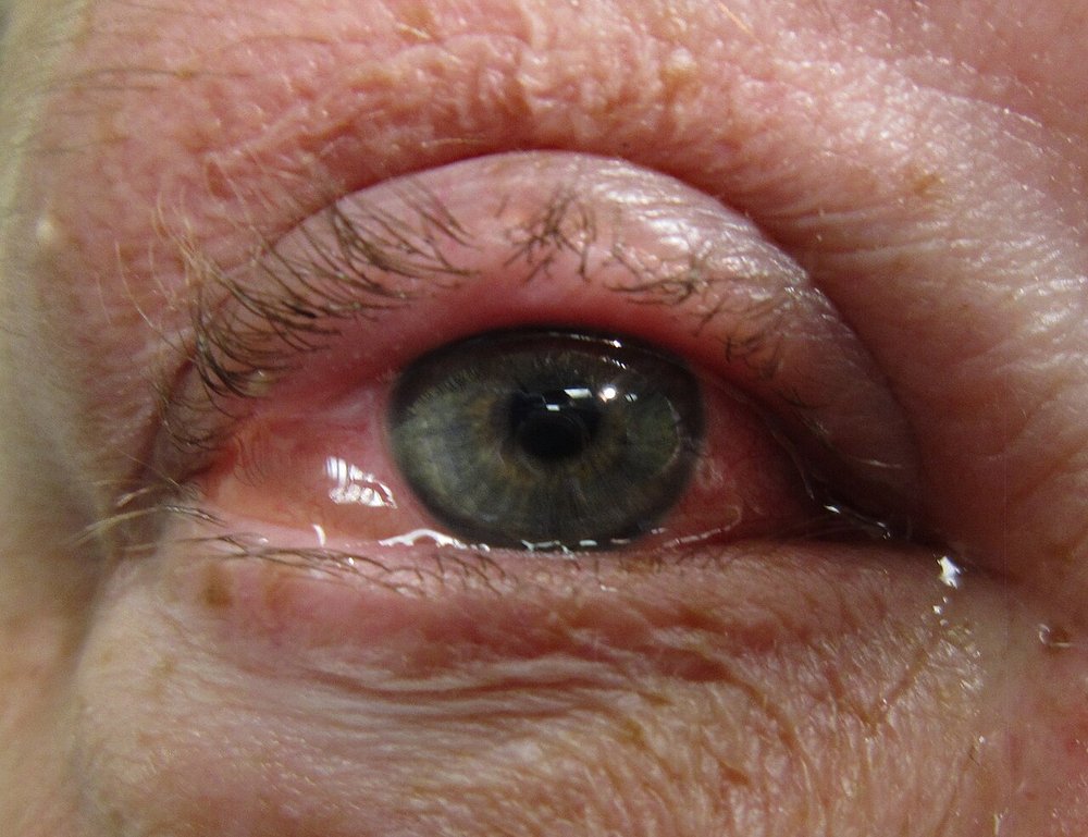 Photo of eye allergy (allergic conjunctivitis, aankhon mein allergy): red, watery eye with puffy, swollen conjunctiva