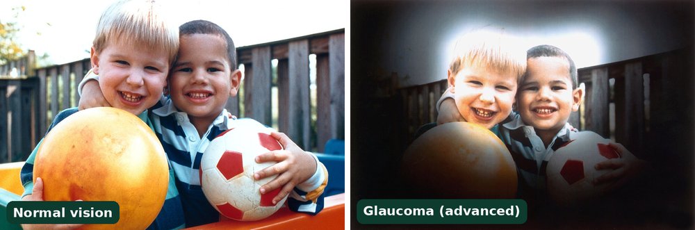 Vision simulation of glaucoma (kala motia): the same photo of two boys holding balls shown with normal vision on the left and as seen with glaucoma on the right