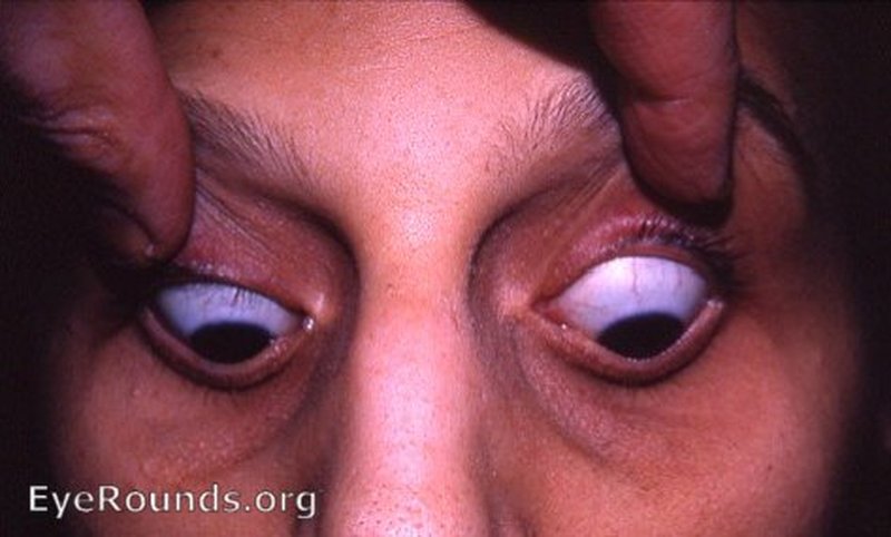 Clinical photo of keratoconus showing Munson's sign: when looking down, the cone-shaped cornea pushes a V-shaped bulge into the lower eyelid