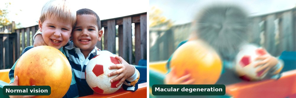 Vision simulation of age-related macular degeneration: the same photo of two boys holding balls shown with normal vision on the left and as seen with age-related macular degeneration on the right