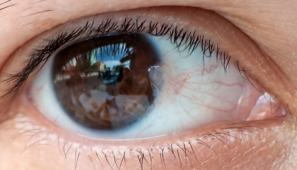 Photo of a pterygium (naakhuna): a fleshy, pinkish wedge of tissue with blood vessels growing from the corner of the eye towards the cornea