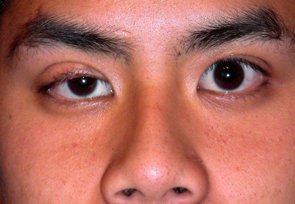 Photo of congenital ptosis (palak latakna): the right upper eyelid droops lower than the left