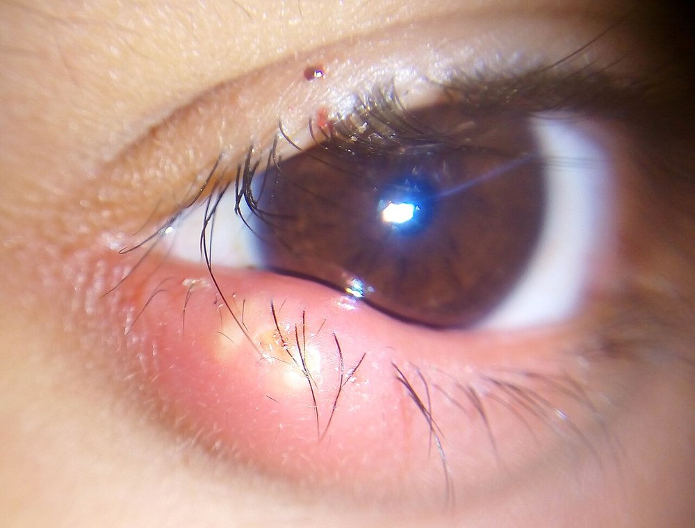 Photo of a stye (gohani / anjani) on a child's lower eyelid: a red, swollen bump at the lid margin
